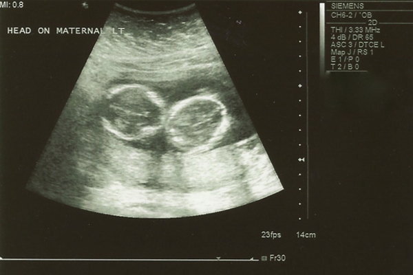 Twins-ultrasound